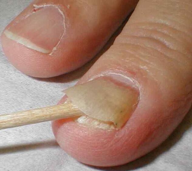 peeling nails with nail fungus