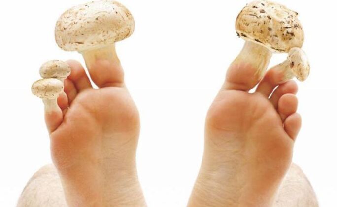 causes, symptoms and treatment of foot fungus