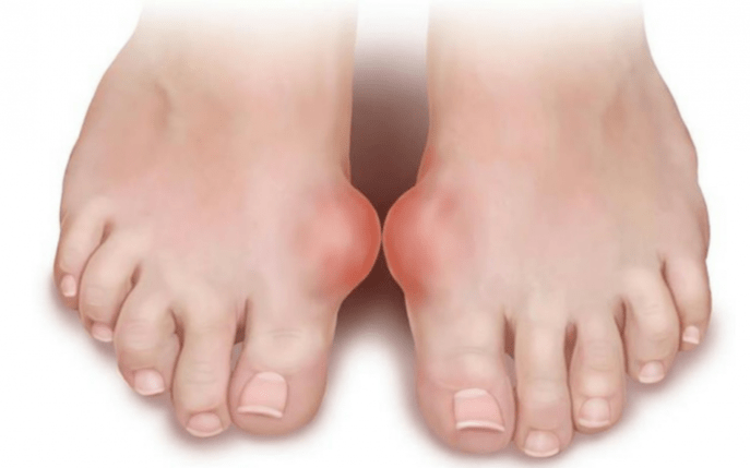 foot deformity as a cause of fungus on the feet