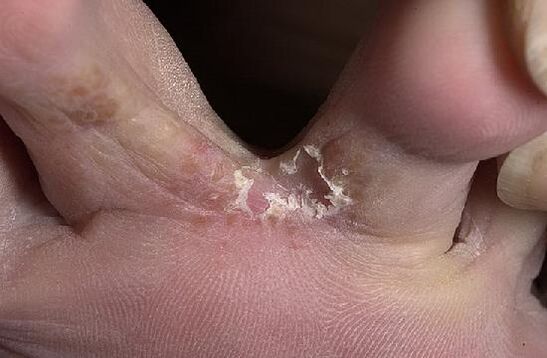 toes affected by fungi