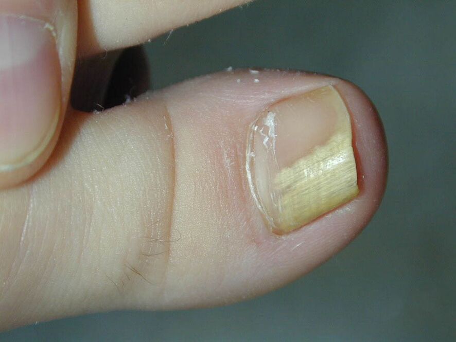 Symptom of the fungus - a change in nail color