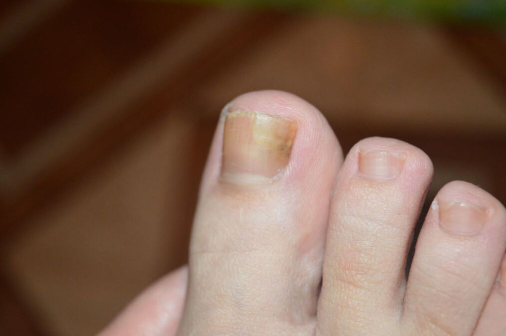 The initial stage of nail fungus