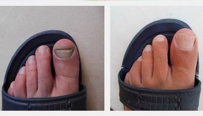 toenails before and after treatment of fungus with apple cider vinegar
