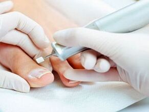 Therapeutic pedicure for toenail fungus