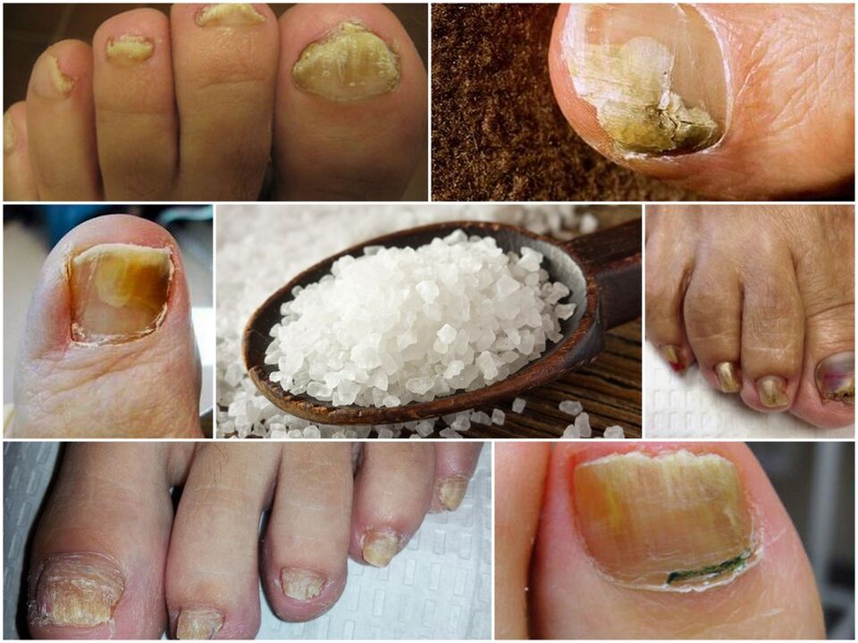 Fight against the fungus