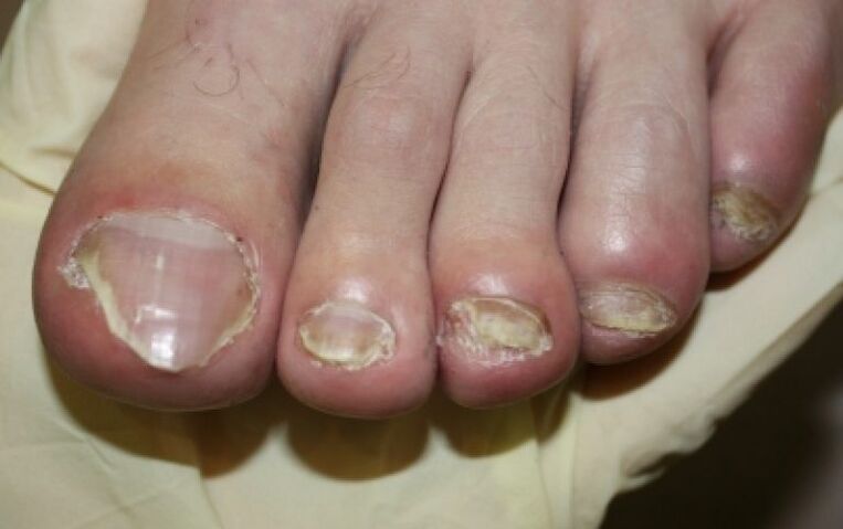 Fungus nail