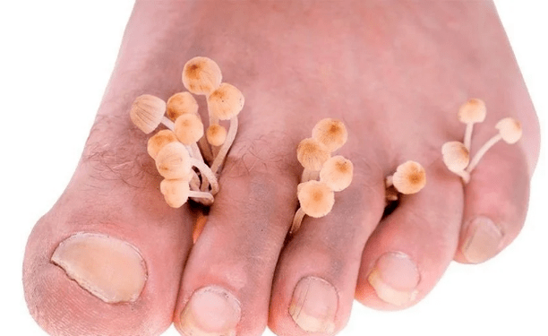 Skin fungus