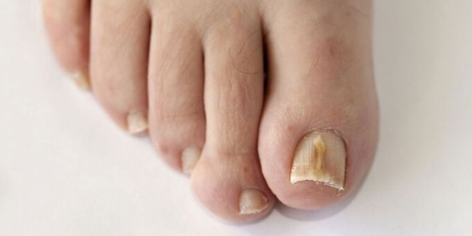 Fungus nail