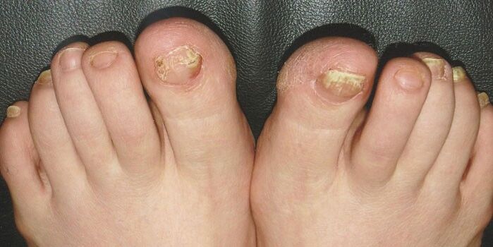 OnihyChomyCosis nail on your feet