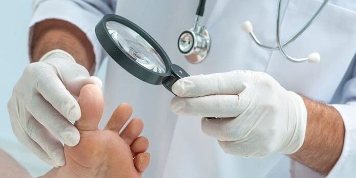 The doctor examined the foot infected with fungi