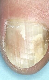Fungus nail