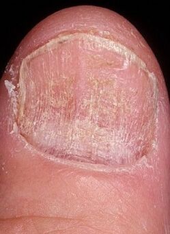 Micosa nail