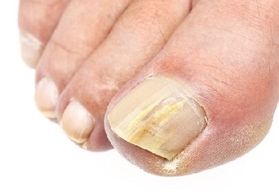 What does nail fungus look like
