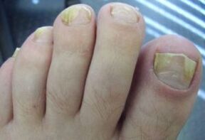 Affected with nails with fungal infections