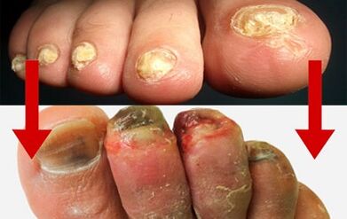Fungi manifestations on the fingers