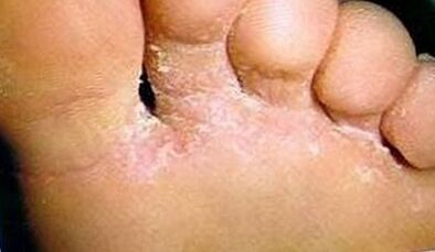 How to recognize the fungus on your fingers