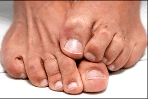 itchy skin of the feet due to a fungal infection of the nails