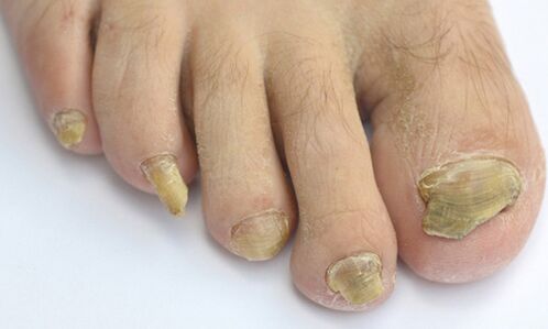 toenail fungus causes and symptoms